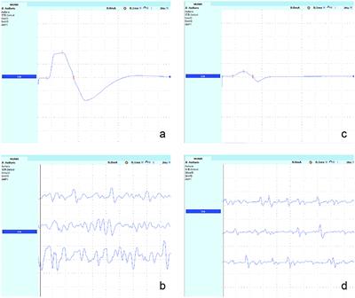 Application Value of the Motor Unit Number Index in Patients With Kennedy Disease